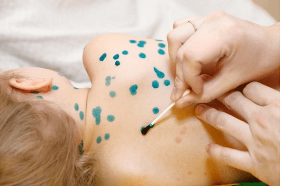 Эпидемиологи в Грузии предупреждают о вспышке ветряной оспы и кори одновременно