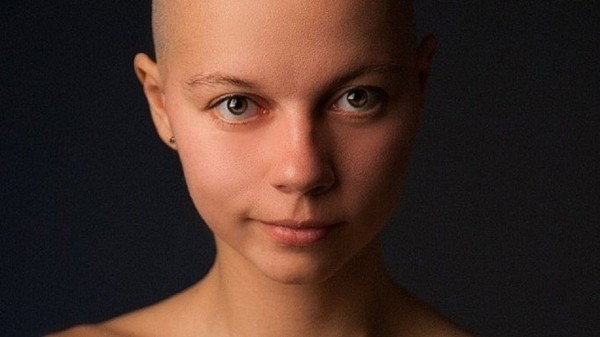 Как жить с редким заболеванием: история девушки без волос