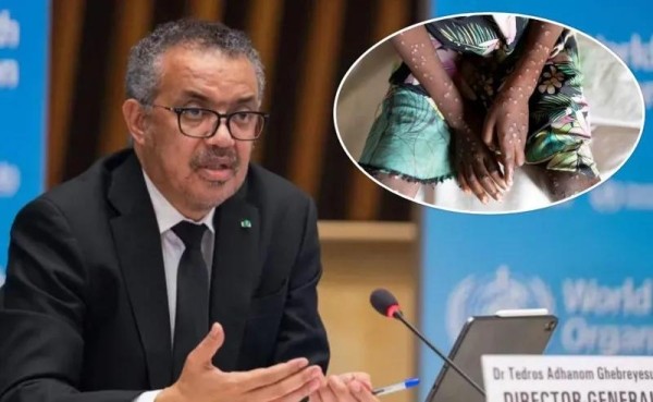 ВОЗ объявила ​​глобальную чрезвычайную ситуацию в связи с «оспой обезьян»