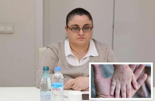 Для начала «оспы обезьян» характерны гриппоподобные симптомы» - Для кого опасен вирус, в связи с которым ВОЗ объявила чрезвычайное положение