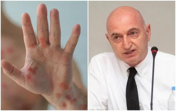 Все родившиеся до 1980 года, кто вакцинирован от оспы, имеют определенную защиту от «оспы обезьян» - Иване Чхаидзе Все родившиеся до 1980 года, кто вакцинирован от оспы, имеют определенную защиту от «оспы обезьян» - Иване Чхаидзе