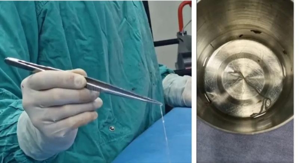 Из мозга пациентки в Грузии извлечен живой паразит длиной 15 см: «Редкий и, возможно, первый случай в истории медицины» Из мозга пациентки в Грузии извлечен живой паразит длиной 15 см: «Редкий и, возможно, первый случай в истории медицины»