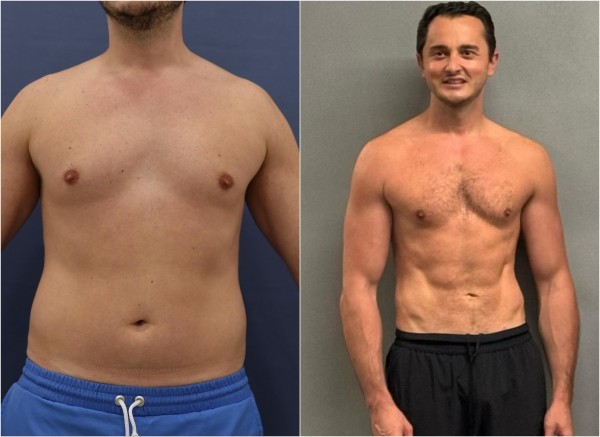 Какие пластические операции делают грузинские политики, актеры и бизнесмены — интервью с известным пластическим хирургом об эстетических желаниях мужчин Какие пластические операции делают грузинские политики, актеры и бизнесмены — интервью с известным пластическим хирургом об эстетических желаниях мужчин