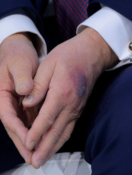 Что случилось с руками Трампа и почему у него синяки? - «Врач мне сказал, что...» Что случилось с руками Трампа и почему у него синяки? - «Врач мне сказал, что...»