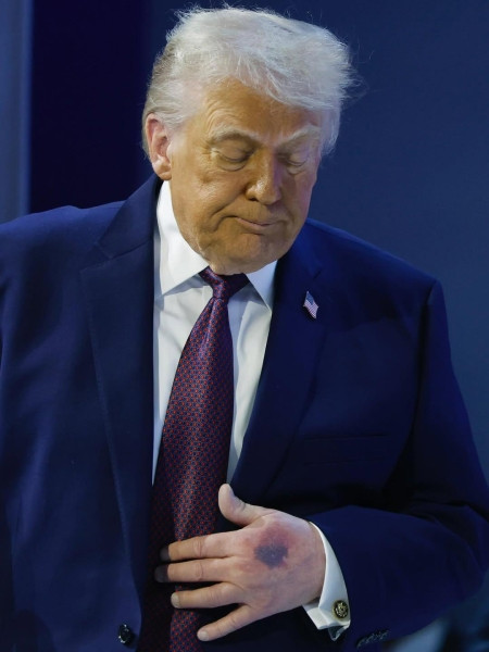 Что случилось с руками Трампа и почему у него синяки? - «Врач мне сказал, что...» Что случилось с руками Трампа и почему у него синяки? - «Врач мне сказал, что...»