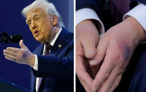 Что случилось с руками Трампа и почему у него синяки? - «Врач мне сказал, что...» Что случилось с руками Трампа и почему у него синяки? - «Врач мне сказал, что...»